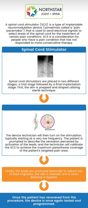 If you have back pain that has not responded to traditional forms of treatment, triple board certified Dr. Robert Nocerini, MD at Northstar Joint and Spine offers a spinal cord stimulator. Spinal cord stimulation is used in a number of different situations, primarily after nonsurgical pain treatment options have failed to provide sufficient relief. Spinal cord stimulators may be used in the treatment or management of various types of chronic pain, including chronic back pain, injuries to the spinal cord, and many others. Contact us today for more information or schedule an appointment online. We are conveniently located at 7704 San Jacinto Pl Suite #200 Plano, TX 75024.